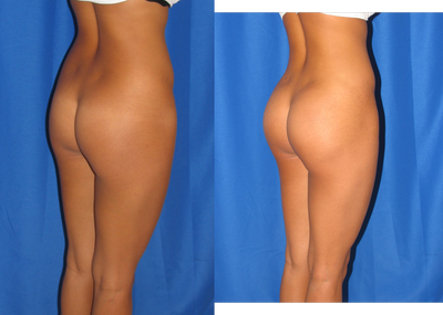 Buttock Implants Before and After - 
	Buttock Implants. Patient too thin and thus, again, not near enough fat for Brazilain Butt Lift fat transfer
