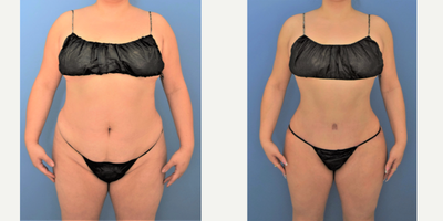 NONCOMP 25-34 year old woman treated with Brazilian Butt Lift - 6 months following tummy tuck (abdominoplasty), Brazilian Butt Lift, lipo 360 and liposuction to the arms. Natural transformation, and thin, hidden scars are the goals.
