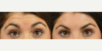 Botox - Woman treated with Botox