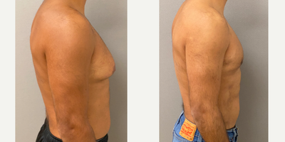 25-34 year old man treated with Gynecomastia Surgery and Liposuction of the abdomen and flanks - 33 yo s/p gynecomastia liposuction with excision and liposuction of the abdomen and flanks performed in our on site AAAA certified operating suite.