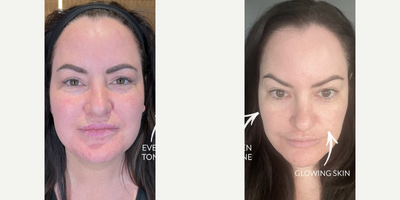 Woman treated with Facial - Woman treated with Facial