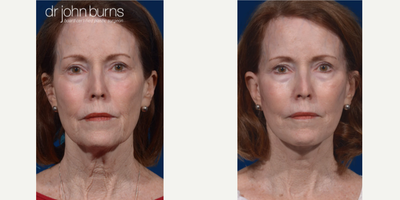 Woman treated with SMAS Facelift - Woman treated with SMAS Facelift with stacking and repositioning as well as Neck Lift with corset platysmaplasty and with short scar incision, and full face laser resurfacing.