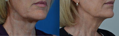 55-64 year old woman treated with Teosyal - Patient treated with Teosyal Redensity on the neck, jaw line, and chin. She had 3 treatments, done 3 weeks apart. She now has improved skin texture and elasticity, and her skin is more hydrated creating a beautiful glow.