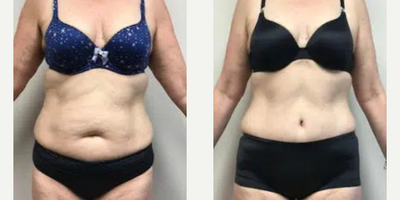 Woman treated with Liposuction - Before and 1 year after a full abdominoplasty with liposuction to the hips