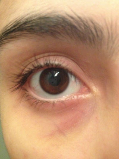 Dilemma for treatment of veins under eyes/tear trough hollows? (Photo ...