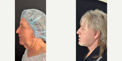 Man treated with Eyelid Surgery - Man treated with Deep Plane Facelift, Neck Lift, Eyelid Surgery to upper eyelids, and Facial Fat Transfer. Post-op, he had masculine improvements in his neck, jawline, cheeks, and eyes.