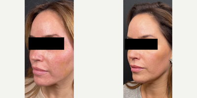 25-34 year old woman treated with Botox, RHA Collection Fillers, Ultherapy, Laser Resurfacing, Neo Laser - This patient received the following treatments: - Tixel, 2 Treatments- Ultherapy, 1 Treatment- NeoAeolase, 2 Treatments- RHA 3 and RHA 4 - Botox