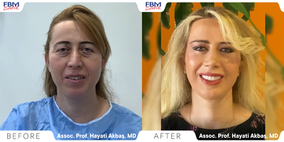 45-54 year old woman treated with Deep Plane Facelift, Double Eyelid Surgery, Facial Fat Transfer, Neck Lift - This patient was suffering from a sad-looking face and eyes. She needed to have a more rejuvenated look. She didn't have any jawlines. She was treated with facial rejuvenation a Deep Plane Facelift, Eyelid Surgery, and Facial Fat Transfer.