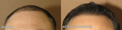 Man treated with ARTAS Robotic Hair Transplant, Hair Transplant - Man treated with ARTAS Robotic Hair Transplant, Hair Transplant