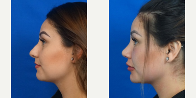 18-24 year old woman treated with Eyelid Surgery - Woman treated with Eyelid Surgery