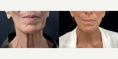 76 year old woman treated with Deep Plane Facelift, Neck Lift, Facial Fat Transfer, CO2 Laser - 76 year old woman treated with Deep Plane Facelift, Neck Lift, Facial Fat Transfer, CO2 Laser