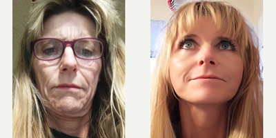 45-54 year old woman treated with Skin Rejuvenation - 45-54 year old woman treated with Skin Rejuvenation