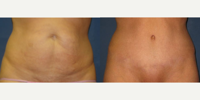 Woman treated with Mini Tummy Tuck - Woman treated with Mini Tummy Tuck