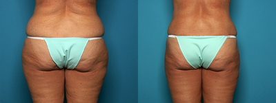 Liposuction after Age 50 - 
	58 year old who had tumescent liposuction of the hips and and outer thighs. Her hip and thigh shape and contour is greatly improved even with her natural age related skin changes.
