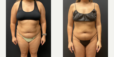 Woman treated with Semaglutide - Woman treated with Semaglutide