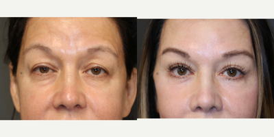 Enigmalift full facial rejuvenation. - Enigmalift upper and lower eyelids with deep plane face and neck lift plus laser.