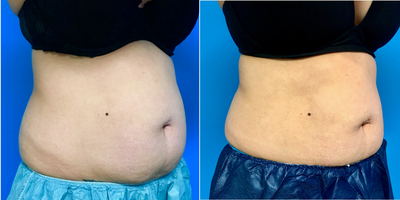 35-44 year old woman treated with CoolSculpting - CoolSculpting treatment of Abdomen & Hips