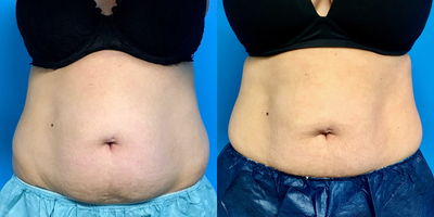 35-44 year old woman treated with CoolSculpting - CoolSculpting of Abdomen & Hips
