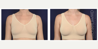 25-34 year old woman treated with Mentor Breast Implants - Breast augmentation. Follow-up photo taken 1 month after the procedure.