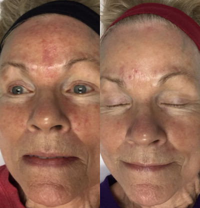 45-54 year old woman treated with Excel V - Patient received significant improvement to facial redness following 4 excel V+ treatments.