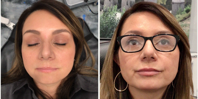 45-54 year old woman treated with Revanesse - 0.9 cc of Revanesse Versa injected into lips for added volume/fullness.