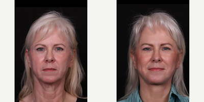 55-64 year old woman treated with Facelift, Deep Plane Facelift, Neck Lift, Eyelid Surgery, Facial Fat Transfer - Deep plane facelift, necklift, fat transfer,  blepharoplasty B&A.