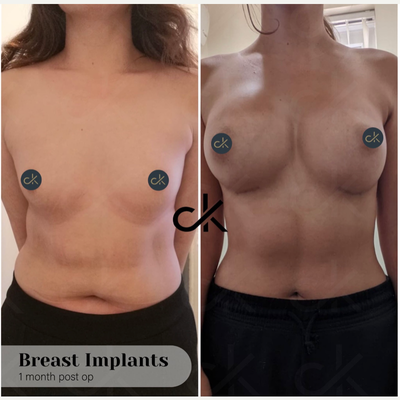 25-34 year old woman treated with Breast Augmentation - We used FDA approved Mentor implants. Her scars are healing very good and fast only one month post surgery.