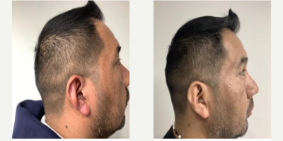 45-54 year old man treated with PRP for Hair Loss, Nutrafol - 3 month combination therapy prp + nutrafol, + minoxdil