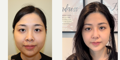 25-34 year old woman treated with Cheekbone Reduction, Genioplasty, Buccal Fat Removal, Jaw Reduction - Facial contouring surgery with combination of several beautifying procedures.