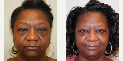 55-64 year old woman treated with Eyelid Surgery, TCA Peel - Blepharoplasty plus TCA peel for lower eyelid rejuvenation