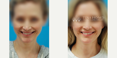35-44 year old woman treated with Deep Mini Neck Lift - 38 year-old female who underwent deep mini neck lift for neck rejuvenation and jawline contouring.