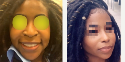 25-34 year old woman treated with Rhinoplasty - African American patient who sent in her photos 1 year post-op after primary rhinoplasty