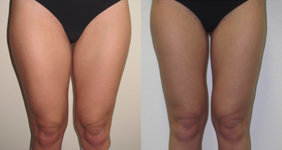 25-34 year old woman treated with Vaser Liposuction - VASER lipo to the inner and outer thighs