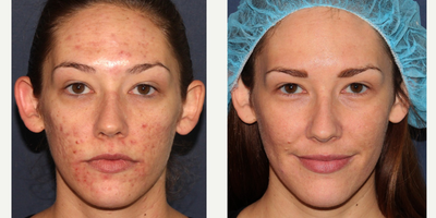 26 year old woman treated with Fraxel Repair - This patient was treated with PDT to clear up active acne, and then treated twice by Dr. Groff with the Fraxel Repair to improve the acne scarring.