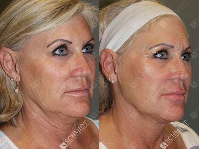 Woman treated with Revision Rhinoplasty - We performed revision rhinoplasty to produce a more desirable shape, and this also significantly improved her nasal breathing. She felt that the external portion nostril was too big and the bottom edge of this tissue was too flat relative to the other side. If you look at the post-operative photos, youll notice that the curved contour of the bottom edge of the nostril on the right more closely matches the untreated left side.
