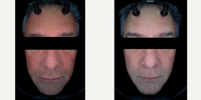 45-54 year old man treated with Laser Genesis - This 56 year old patient was concerned about redness, rosacea, facial vessels and cherry anginoma on his forehead. We treated the patient 4 times with Laser Genisis&copy; treatments, along with some Cool Glide ND: Yag&copy; laser for the cherry anginoma. The after photo was taken 4 weekd post treatment.