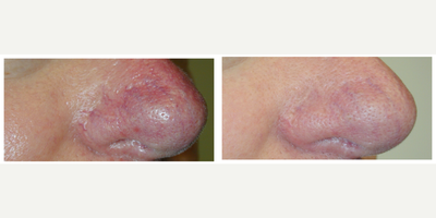 55-64 year old man treated with Pulsed Dye Laser - 55-64 year old man treated with Pulsed Dye Laser