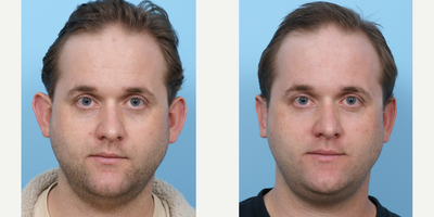 35-44 year old man treated with Ear Surgery - This patient was bothered by his protruding ears and felt they made him look juvenile. He had ear pinning (otoplasty) surgery to not only set back the bowl of the ear, but to help redefine the contours and curves of the ear.