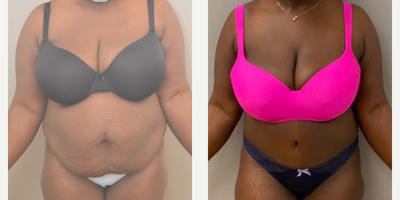 47 year old woman treated with Diastasis Recti Repair as well as Tummy Tuck - 47 year old woman treated with Diastasis Recti Repair as well as Tummy Tuck