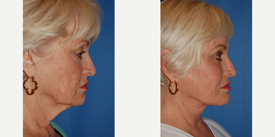 Woman treated with Cheek Implants - Woman treated with Cheek Implants
