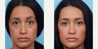 Woman treated with Eyelid Surgery - Dr. Balikian preformed a Lower Blepharoplasty with fat transfer to her lower eyes and cheeks 1 month ago. She still has plenty of healing to do, but her overall her results are great so far