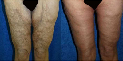 55-64 year old woman treated with Body Lift - Dr. Katzen performed his signature 360 circumferential lower body lift, thigh liposuction, and bilateral medial vertical thigh lift. This is a 56 year-old female who weighed 315lbs. at her heaviest. This patient underwent a RNY gastric bypass and lost 160lbs. After her weight loss, she did not like her sagging, wrinkled buttocks or her inner loose and wrinkled thighs. Dr. Katzen combined these procedures. During the 360 circumferential lower body lift, an incision was made at the top of the buttocks and extended to the lower abdomen.