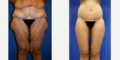 55-64 year old woman treated with Body Lift - Dr. Katzen performed his signature 360 circumferential lower body lift, bilateral hip wedge resection, and bilateral vertical thigh lift/reduction. This is a 57-year-old female who weighed 269 pounds at her heaviest. She underwent a RNY gastric bypass and lost 150 pounds. After her weight loss, she did not like her central abdomen, pubic region, saddlebags, and inner thighs. Dr. Katzen removed 16 pounds.