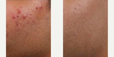 Patient treated with Skin Rejuvenation - Treat mild, moderate, and severe acne in just three, 30-minute AviClear sessions. This patient completed three sessions and the after pic is three months after his final session.