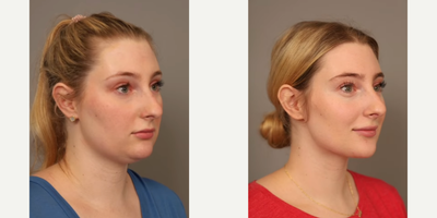 Woman treated with Smart Lipo - Woman treated with Chin Liposuction through Smart Lipo. Pre-op, patient had fullness behind her chin since childhood, regardless of her weight.