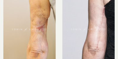 45-54 year old woman treated with Scar Removal - 45-54 year old woman treated with full thickness skin loss on posterior arms following VASER liposuction. Patient's arms were treated with 3 rounds of fat transfer with excision of the contracted scar as a final stage reconstruction. Patient continuing to undergo microneedling of the surgical scar.