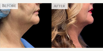 Woman treated with Chin Liposuction, Liposuction - This lovely patient is 6 weeks out from chin liposuction and we are obsessed with her amazing results! Chin liposuction can be an effective way to get rid of a stubborn double chin and contour the jawline.