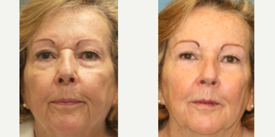 55-64 year old woman treated with Radiesse - This patient was concerned with a prominent line between her brows and her mouth area. She was treated with Botox, Juvederm, and Radiesse.