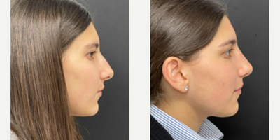 Woman treated with Rhinoplasty - Rhinoplasty