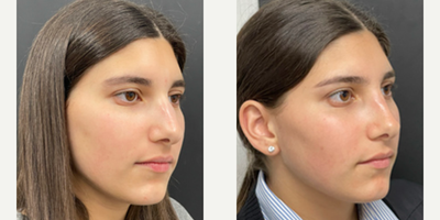 Woman treated with Rhinoplasty - Rhinoplasty
